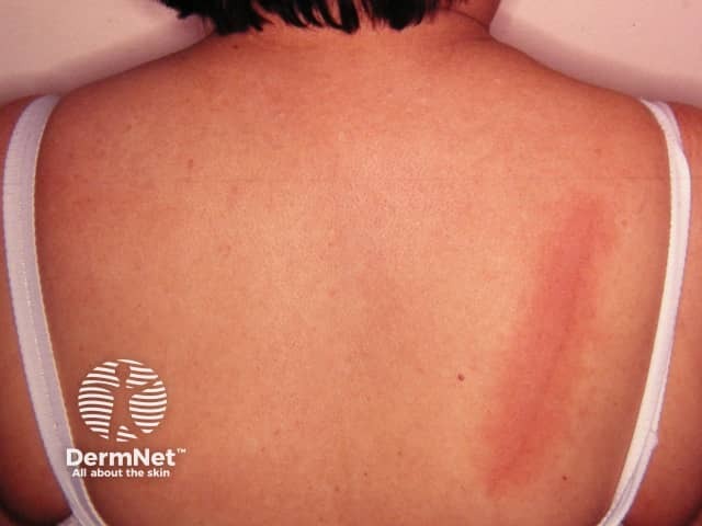 Дермографизм: выраженный уртикарный дермографизм