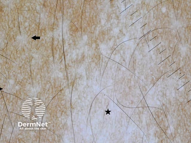 Дерматоскопическое изображение ахромического невуса на туловище у пациента с темным фототипом кожи: визуализируются белые бесструктурные зоны (отмечены звездочкой)