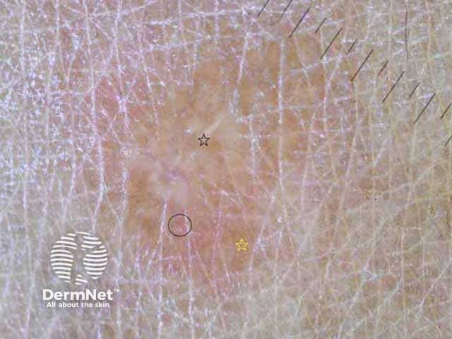 Туберкулоидная лепра, дерматоскопическая картина 00001