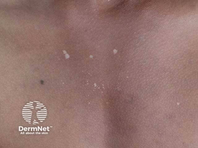 Склероатрофический лишай: общий вид клинической картины