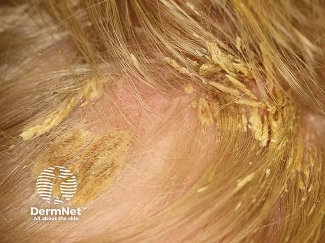 Асбестовидный лишай (Pityriasis amiantacea)