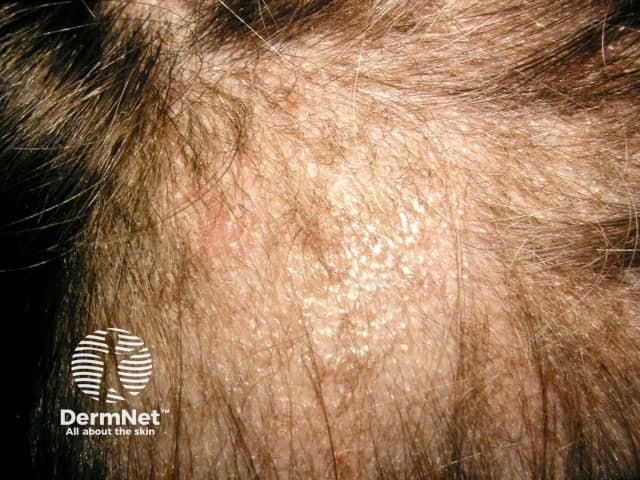Микоз волосистой части головы (Tinea capitis)