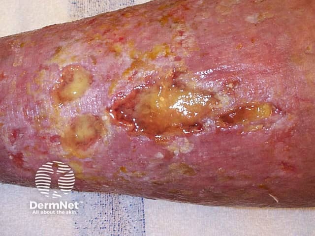 Венозная язва нижних конечностей с признаками липодерматосклероза