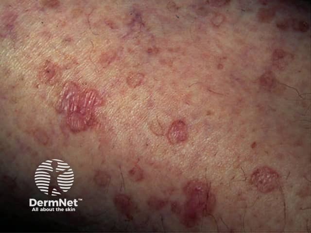 ДПАП: множественные округлые бляшки на коже голени