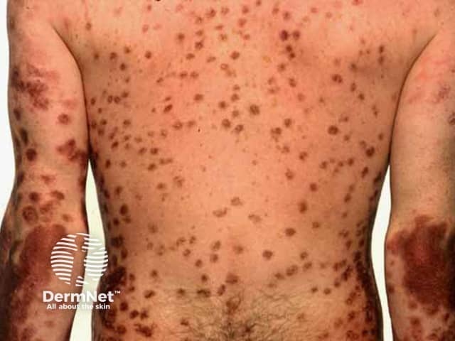 Дитранол: окрашивание псориатической бляшки и окружающей кожи
