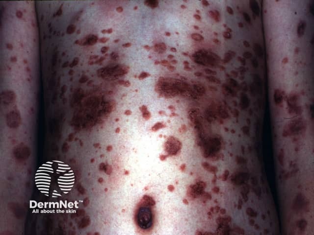 Временная гиперпигментация и эритема на фоне терапии дитранолом