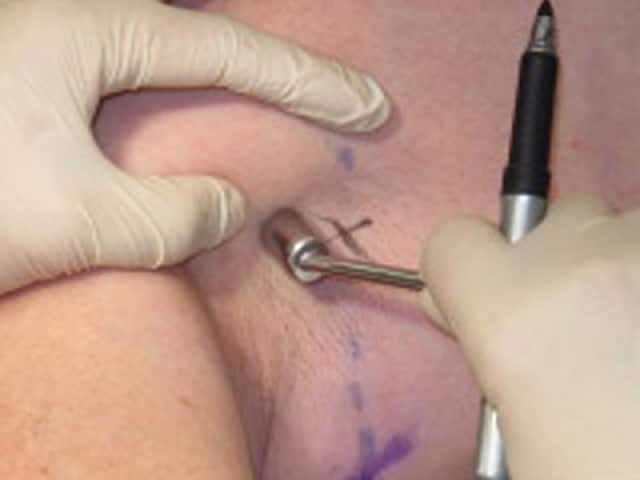 Поиск сигнального (сторожевого) лимфатического узла