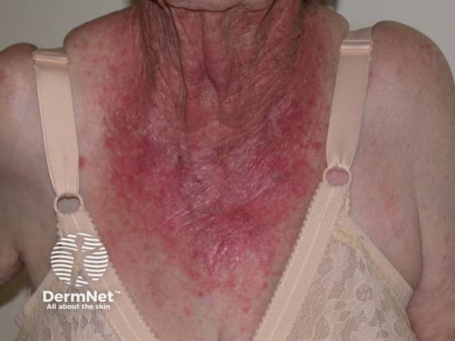 Фототоксическая лекарственная реакция, вызванная пероральным нестероидным противовоспалительным препаратом