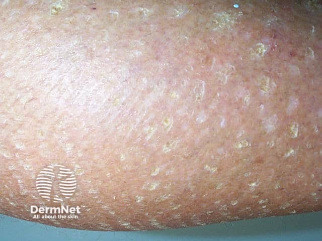 Ихтиоз крупным планом