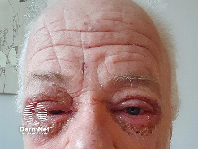Поражение глазной поверхности, индуцированное дупилумабом, через 8 недель после начала терапии