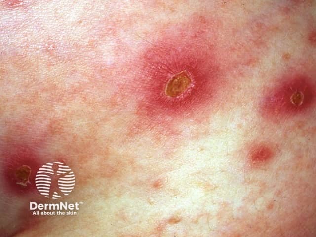 Вульгарная эктима: плотная корка на эритематозном основании
