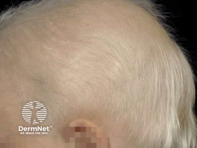 Ангидротическая эктодермальная дисплазия