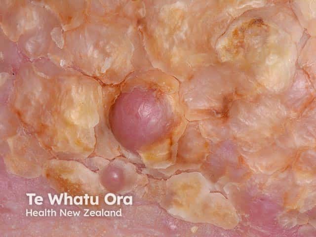 Узлы и гиперкератоз при бородавчатой слоновости нострас (elephantiasis nostras verrucosa)