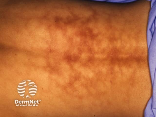 Тепловая эритема (erythema ab igne): характерный ретикулярный сосудистый рисунок