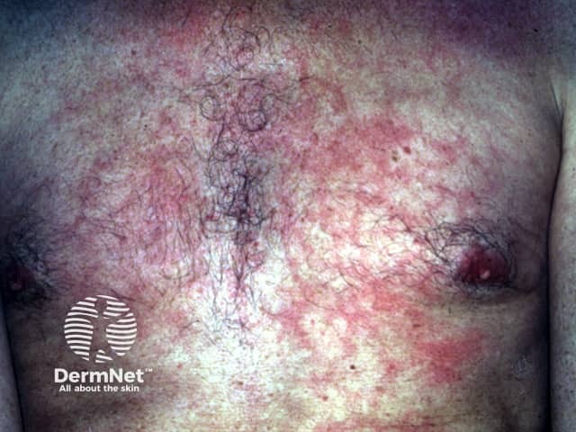 Тепловая эритема (erythema ab igne): сетчатая гиперпигментация