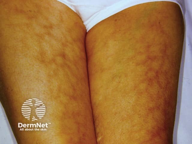 Тепловая эритема (erythema ab igne): сетчатая эритематозная сыпь
