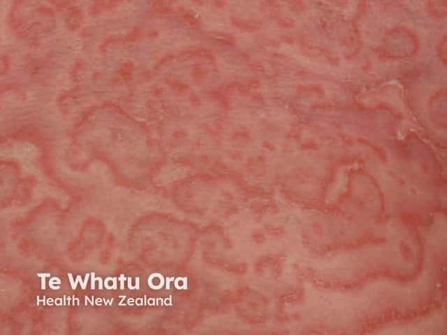 Проявления, напоминающие извитую ползучую эритему (erythema gyratum repens), при листовидной пузырчатке