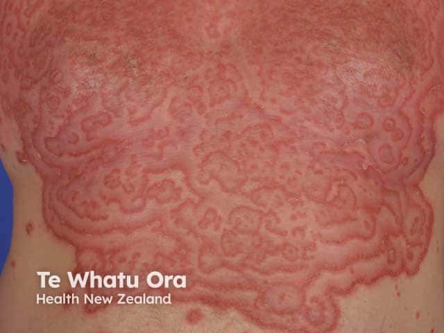 Проявления, напоминающие извитую ползучую эритему (erythema gyratum repens), при листовидной пузырчатке
