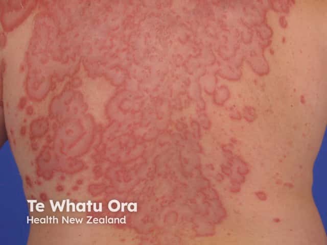 Проявления, напоминающие извитую ползучую эритему (erythema gyratum repens), при листовидной пузырчатке
