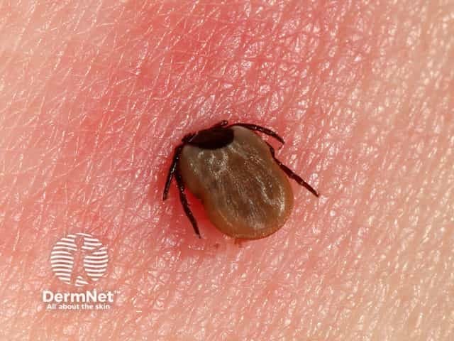 Иксодовый клещ (Ixodes tick)