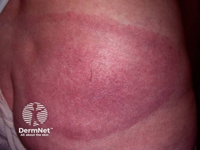 Хроническая мигрирующая эритема (Erythema chronicum migrans)