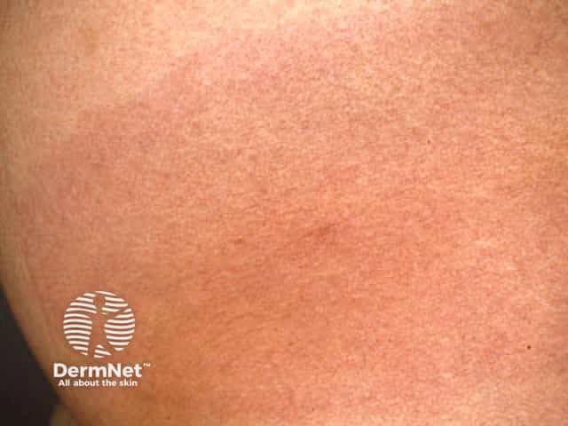 Хроническая мигрирующая эритема (Erythema chronicum migrans)