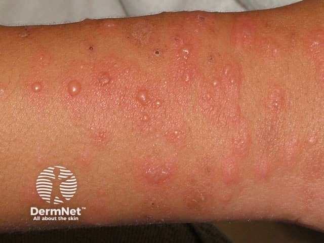 Характерные мишеневидные элементы сыпи