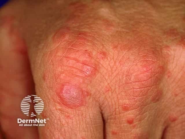 Мишеневидные очаги на коже