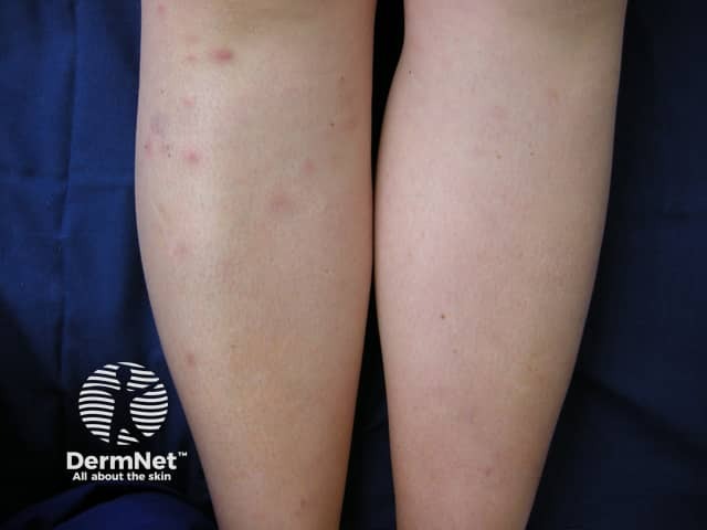 Узловатая эритема: эволюция узлов с изменением окраски («цветение синяка»)