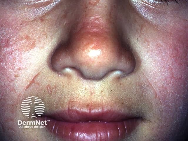 Эритропоэтическая протопорфирия: умеренная эритема и отечность тыла кистей после инсоляции