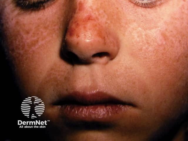 Эритропоэтическая протопорфирия: клинические проявления фоточувствительности на открытых участках кожи