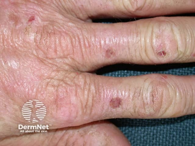 Эритропоэтическая протопорфирия: эритематозные изменения лица и ушных раковин
