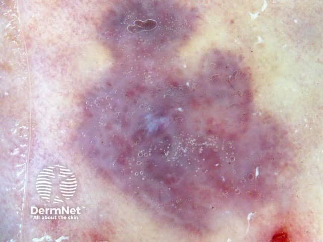Повреждение и некроз окружающей здоровой кожи