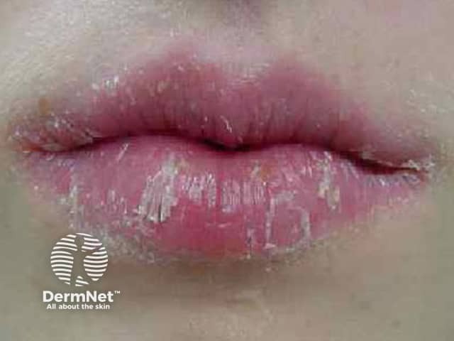 Эксфолиативный хейлит: выраженное циклическое шелушение красной каймы губ