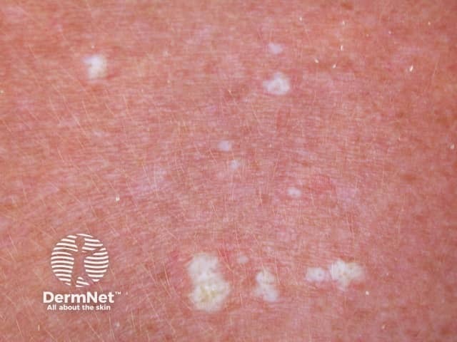 Экстрагенитальный склероатрофический лишай