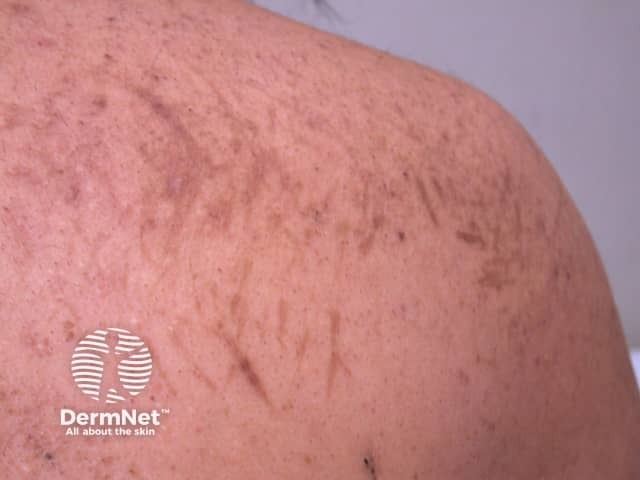 Флагеллярная эритема в фазе поствоспалительной гиперпигментации