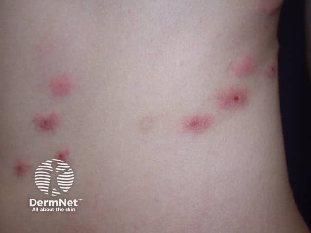 Укусы блох: сгруппированные эритематозные папулы на коже нижней конечности