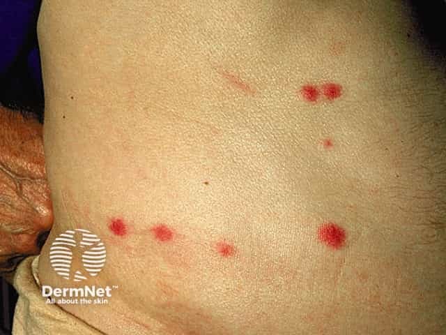 Укусы блох: папуло-уртикарные элементы с центральной точечной экскориацией