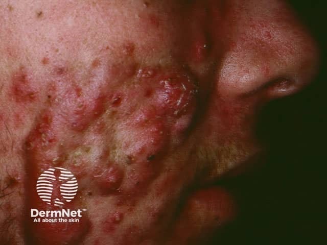 Конглобатные угри спины со сливными абсцессами и рубцеванием