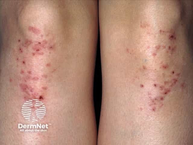 Герпетиформный дерматит Дюринга (везикулезная зудящая сыпь)