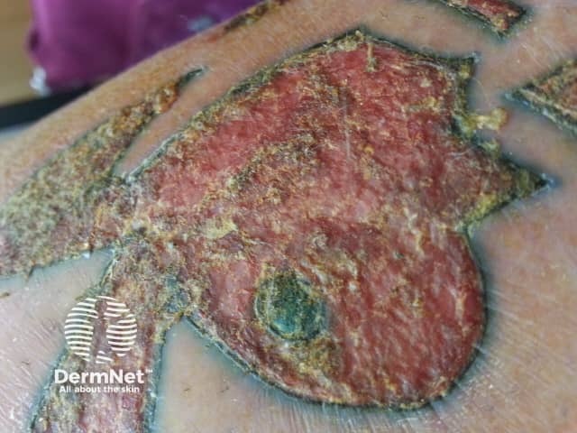 Гранулематозная реакция на татуировку