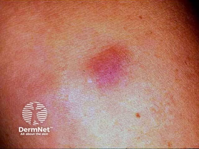Гранулема после инъекции бычьего коллагена