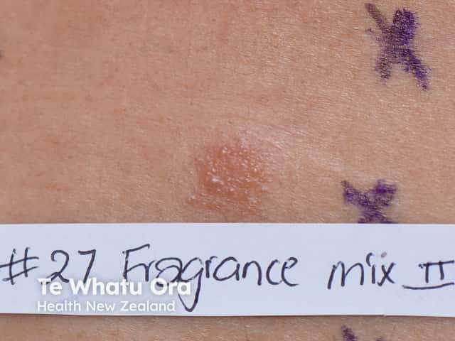 Положительный результат патч-теста на отдушки — смесь ароматизаторов II (Fragrance Mix II)