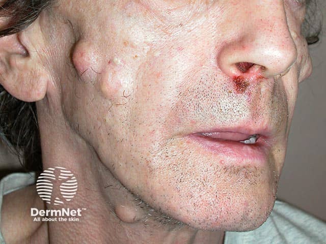 Множественные эпидермальные кисты кожи лица при синдроме Гарднера