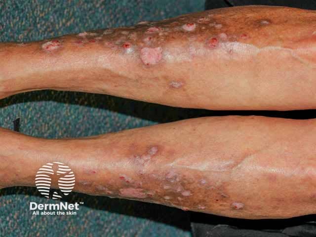 Гиперкератотические очаги поражения на коже нижних конечностей при генерализованных эруптивных кератоакантомах