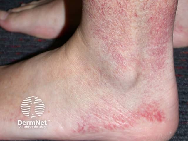 Эссенциальная телеангиэктазия: сливающиеся телеангиэктазии