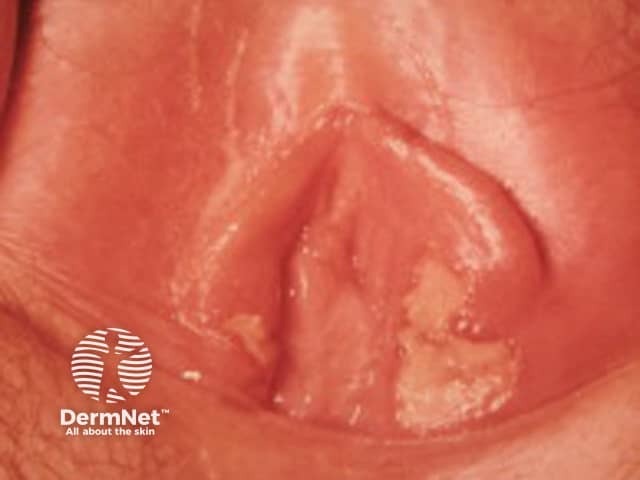 Простой герпес (Herpes simplex)