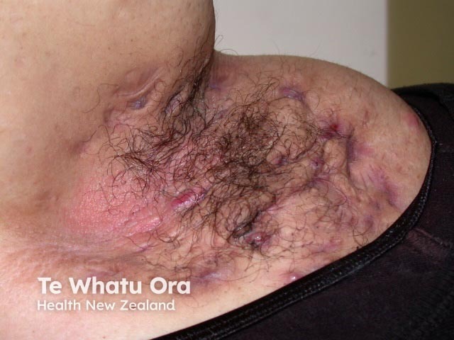 Гнойный гидраденит подмышечной области у пациента с ожирением