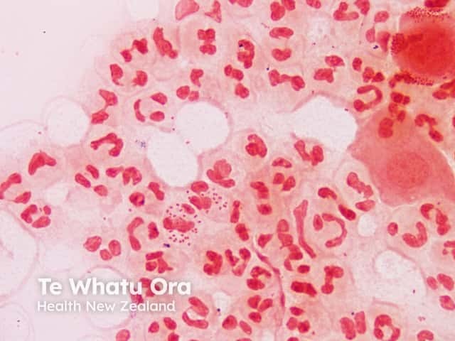 Окраска мазка по Граму: скопления грамотрицательных диплококков Neisseria gonorrhoeae внутри лейкоцитов