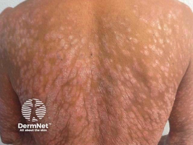 Тяжелый бляшечный псориаз с поражением кожи спины